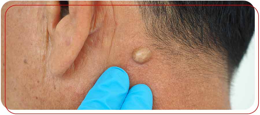 Abscess Drainage Doctor Near Me in Bradenton, FL Abscess Drainage Doctor Near Me in Bradenton, FL