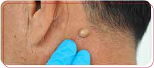 Abscess Drainage Doctor Near Me in Bradenton, FL Abscess Drainage Doctor Near Me in Bradenton, FL