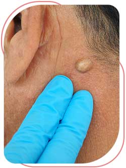 Abscess Drainage Near Me in Bradenton, FL