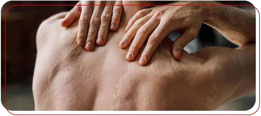 Minor Burn Care Clinic Near Me in Bradenton, FL Minor Burn Care Clinic Near Me in Bradenton, FL