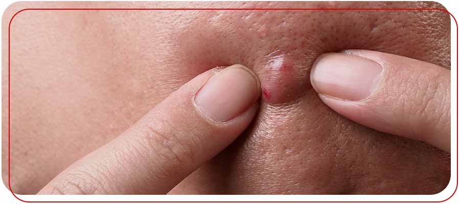 Incision and Drainage (I&D) of Abscesses in Bradenton, FL Incision and Drainage (I&D) of Abscesses in Bradenton, FL