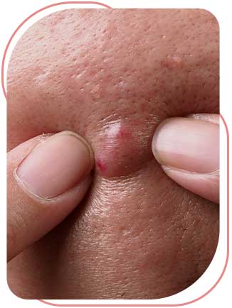 Incision and Drainage (I&D) of Abscesses Near Me in Bradenton, FL