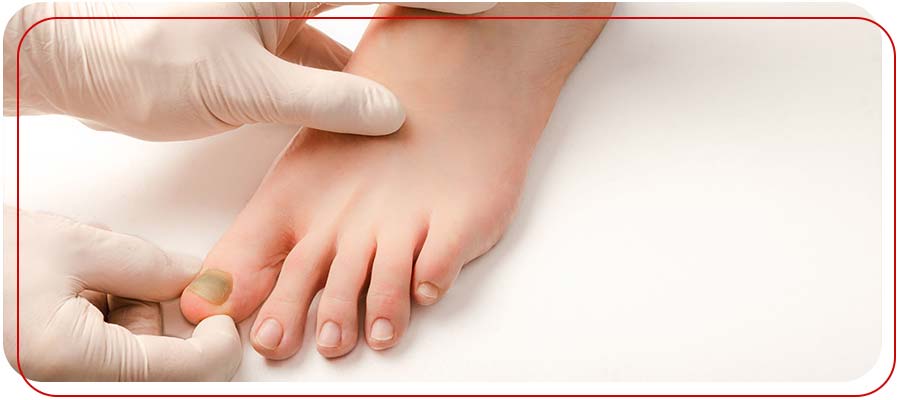 Nail Trephination for Subungual Hematoma in Bradenton, FL Nail Trephination for Subungual Hematoma in Bradenton, FL