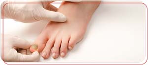Nail Trephination for Subungual Hematoma in Bradenton, FL Nail Trephination for Subungual Hematoma in Bradenton, FL