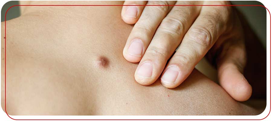 Skin Tag Removal Clinic Near Me in Bradenton, FL Skin Tag Removal Clinic Near Me in Bradenton, FL