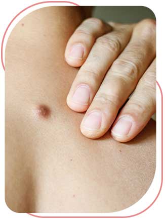 Skin Tag Removal Near Me in Bradenton, FL