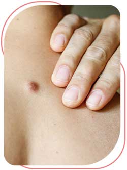 Skin Tag Removal Near Me in Bradenton, FL