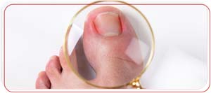 Ingrown Toenail Removal Clinic Near Me in Bradenton, FL Ingrown Toenail Removal Clinic Near Me in Bradenton, FL