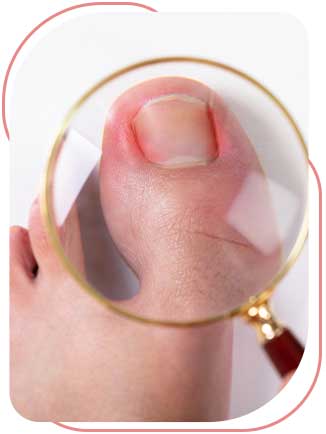 Ingrown Toenail Removal Near Me in Bradenton, FL
