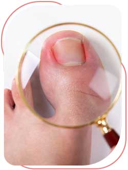 Ingrown Toenail Removal Near Me in Bradenton, FL