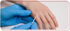 Skin Wart Removal Clinic Near Me in Bradenton, FL Skin Wart Removal Clinic Near Me in Bradenton, FL