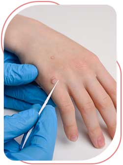 Skin Wart Removal Near Me in Bradenton, FL
